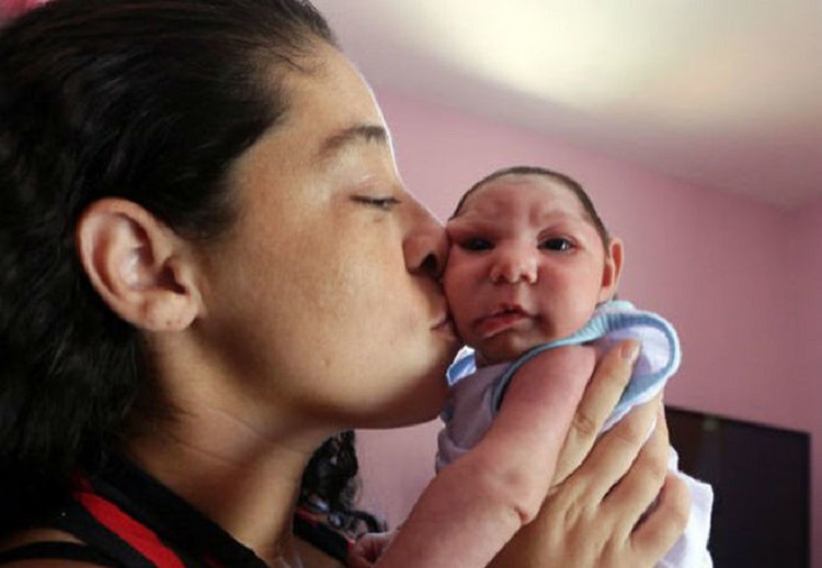 Crianças Com Microcefalia Poderão Receber Pensão Vitalícia Segundo Ministério Da Cidadania 9582